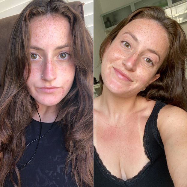 Before and after acne